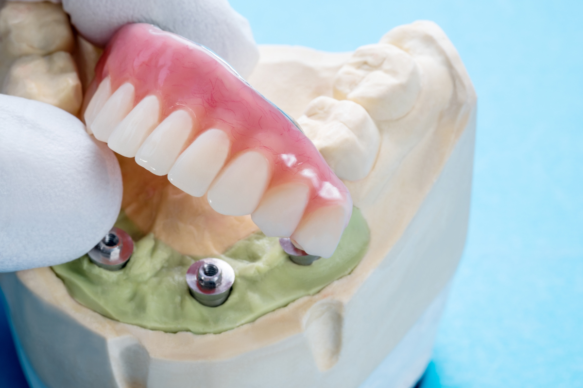 Implantes dentales subperiósticos o implantes sin hueso: todo lo que necesitas saber