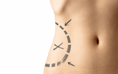 3 cosas que debes saber antes de una liposuccion