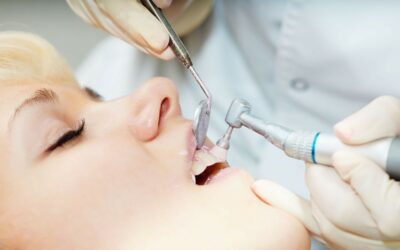 5 preguntas frecuentes sobre el pulido dental