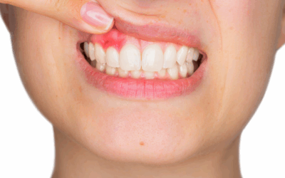 Alargamiento de corona: en que consiste esta cirugia dental
