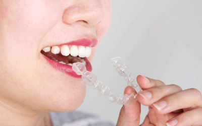 Invisalign , la solucion de ortodoncia mas comoda y estetica