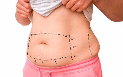 Abdominoplastia: que es y para quien se recomienda