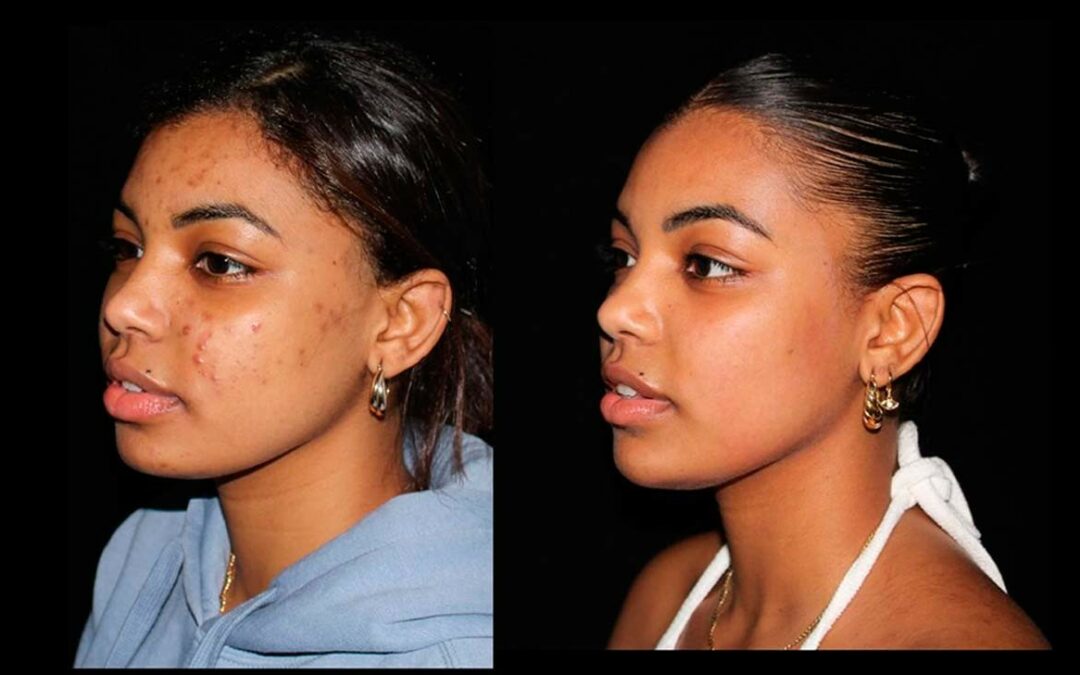Lifting Facial y Bichectomía: Cómo Transformar y Definir tu Rostro