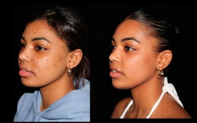 Lifting Facial y Bichectomía: Cómo Transformar y Definir tu Rostro