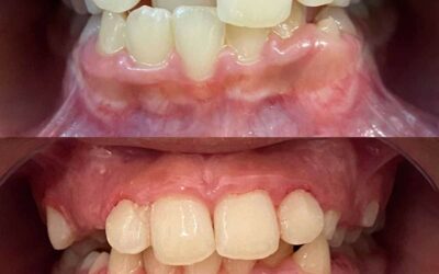 Antes y después de un tratamiento con ortopedia dental