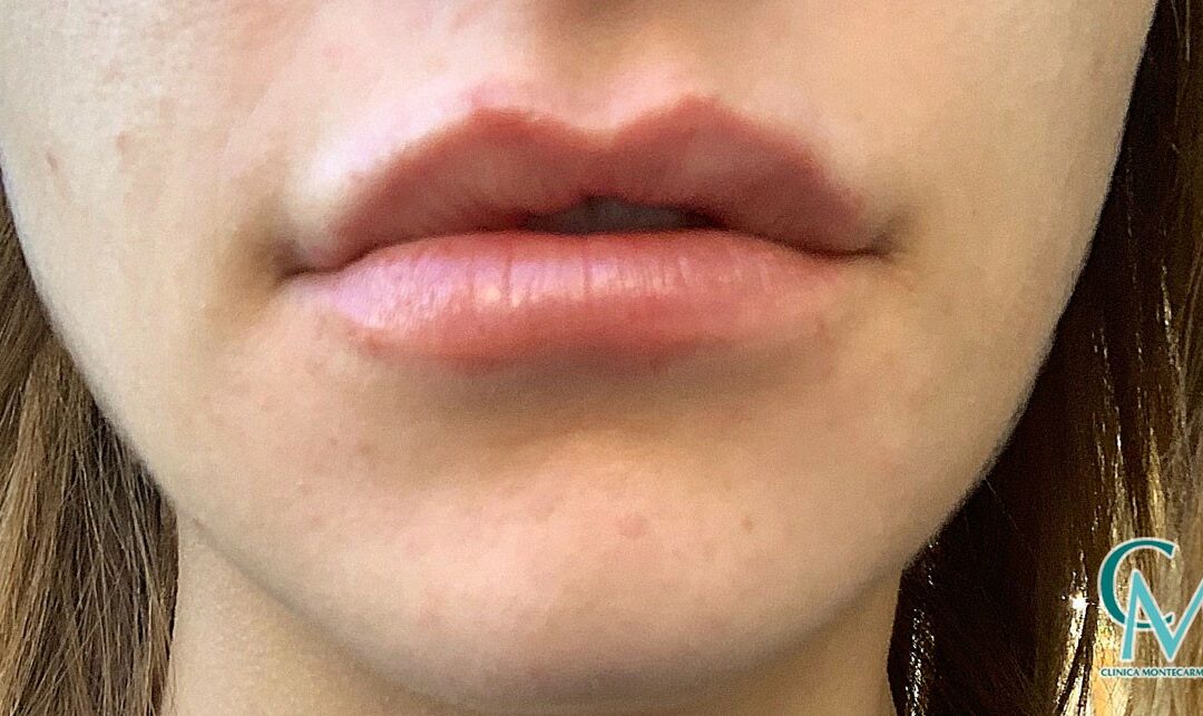 Caso real: aumento de labios en Clínica Montecarmelo