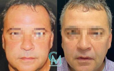 Antes y después de una bichectomía en Clínica Montecarmelo