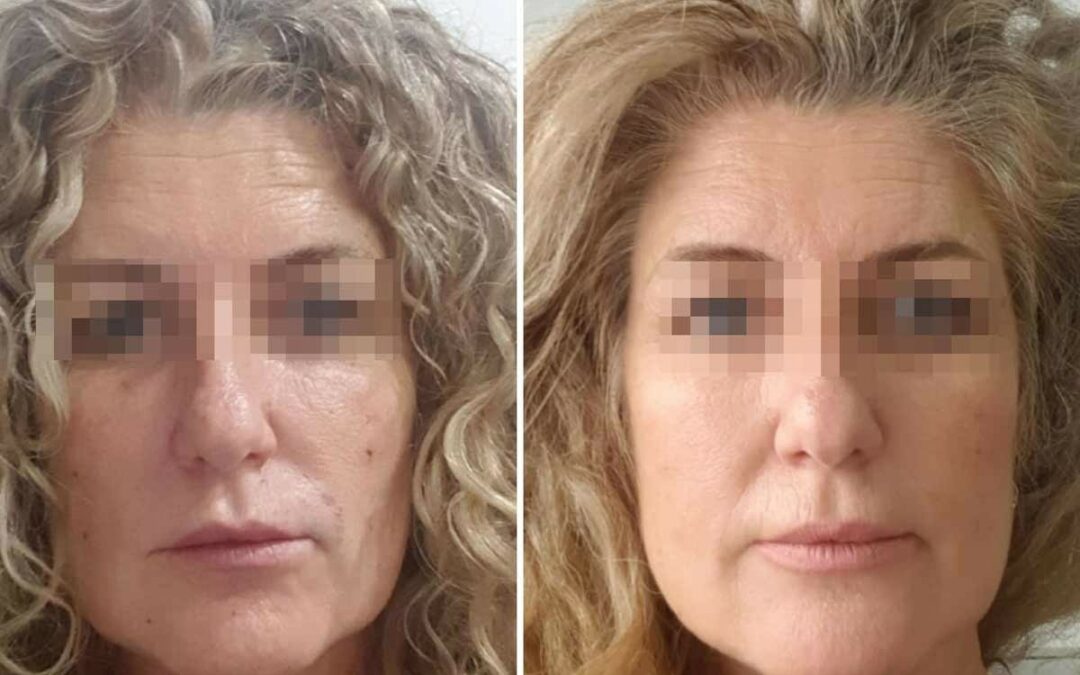 ‘Full face’, el tratamiento global para rejuvenecer tu rostro