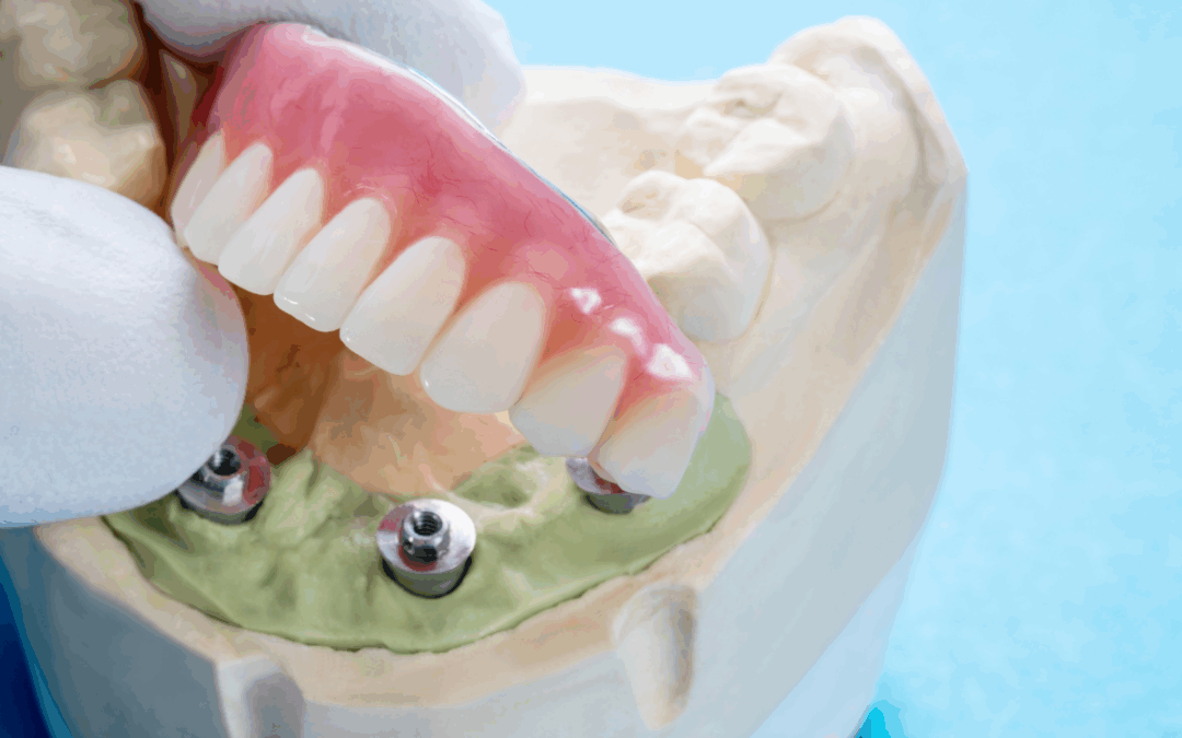 Implantes dentales subperiósticos o implantes sin hueso: todo lo que necesitas saber