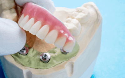 Implantes dentales subperiósticos o implantes sin hueso: todo lo que necesitas saber