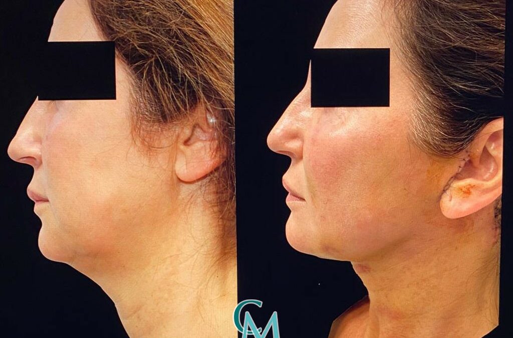 Lipotransferencia para combatir el envejecimiento facial