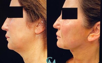 Lipotransferencia para combatir el envejecimiento facial
