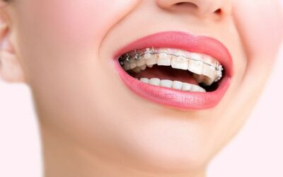 ¿Necesitas una ortodoncia?Descubre los tipos que hay