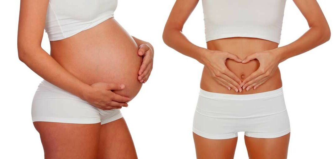 Que es el ‘mommy makeover’ y porque esta tan de moda
